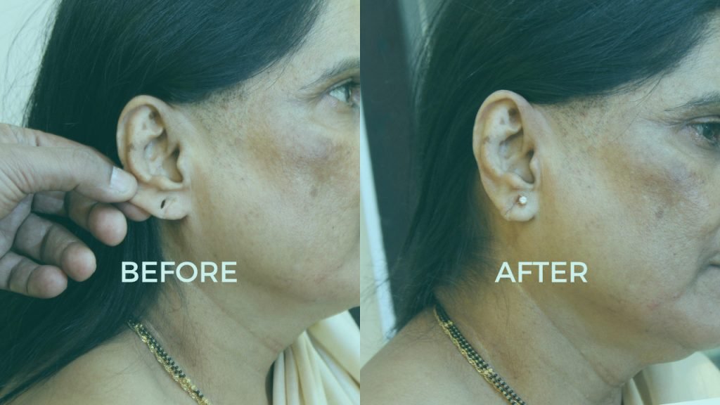 Before and after image showcasing a woman's ear, highlighting the transformation from an unpierced to a pierced state in Mumbai.jpg