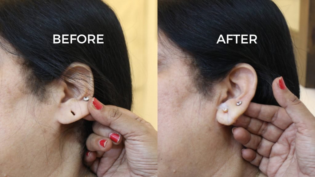 EARHOLE