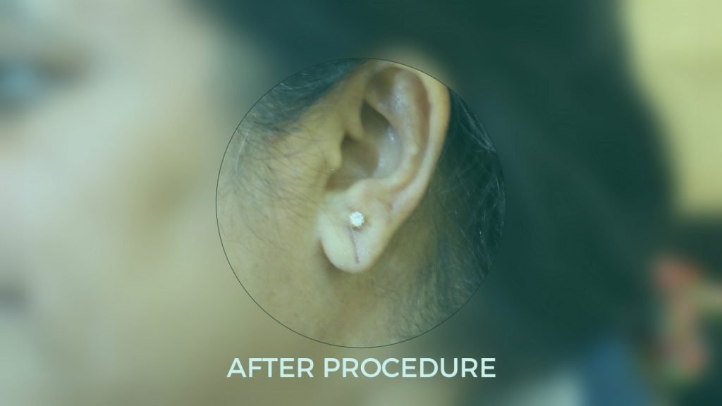 A woman in Mumbai showcasing her ear with a diamond piercing, highlighting elegance and style.jpg