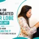 Torn or Elongated Ear Lobe in Delhi